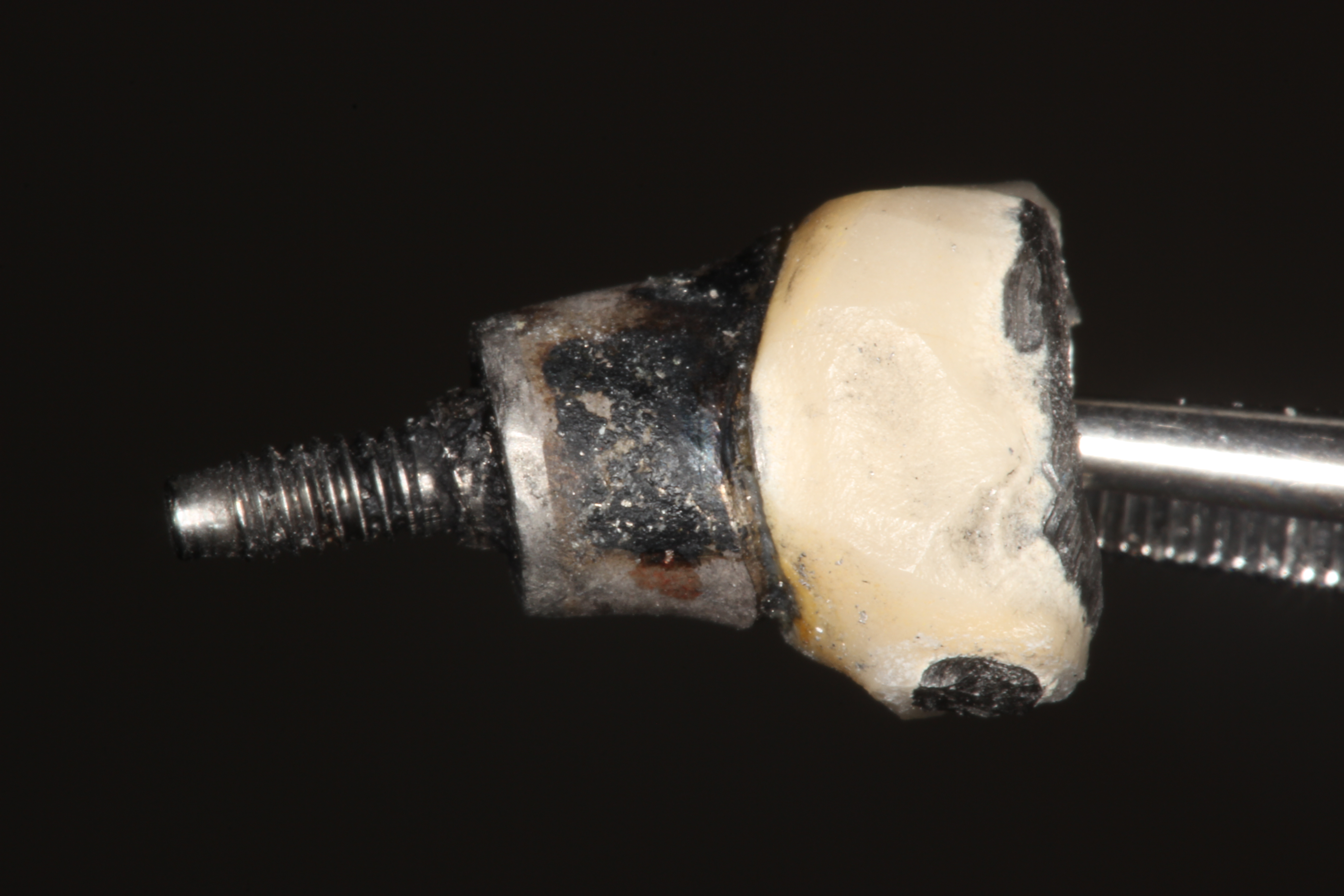 Example of low-quality implants installed in Mexico. It didn't last long and came out.